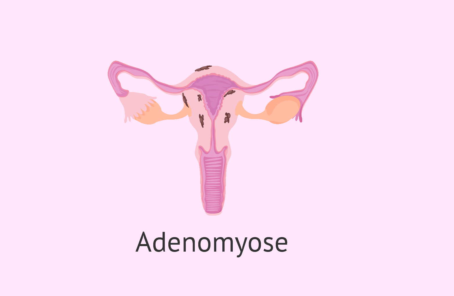 Was ist Adenomyose?