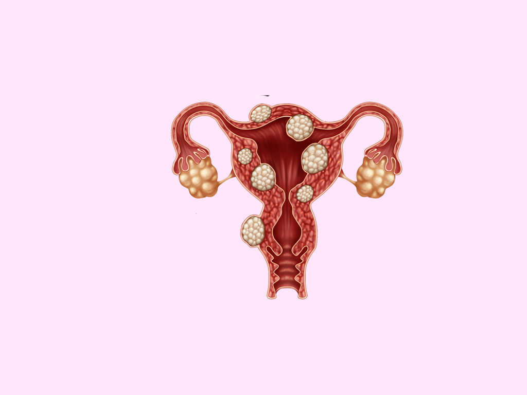 Was ist Endometriose?